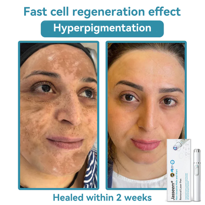 𝐉𝐚𝐬𝐬𝐞𝐞𝐦® Medical-Grade Laser Pen 💕 (Powered by CO₂ laser technology – effectively removes moles, warts, skin tags, pigmentation marks, and other skin imperfections)🏆