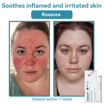 𝐉𝐚𝐬𝐬𝐞𝐞𝐦® Medical-Grade Laser Pen 💕 (Powered by CO₂ laser technology – effectively removes moles, warts, skin tags, pigmentation marks, and other skin imperfections)🏆